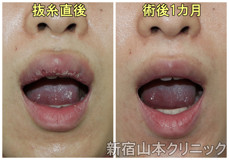 唇切ったら激腫れ 口唇縮小術 新宿 山本クリニック Note