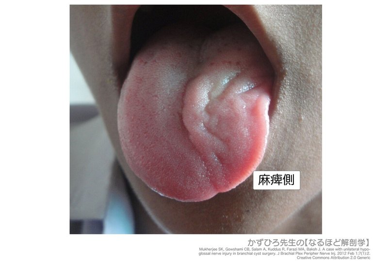 消化器系-4-1-舌下神経マヒ-SQ図c