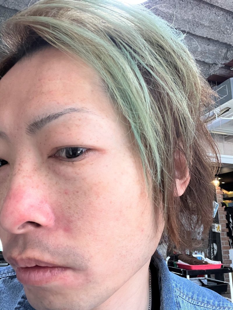 シミ取り放題 そばかす経過報告 Hiro美容師 特殊ヘア美容講師 フリーランス プライベートシェアサロン アニメ好き 大阪兵庫姫路 Note