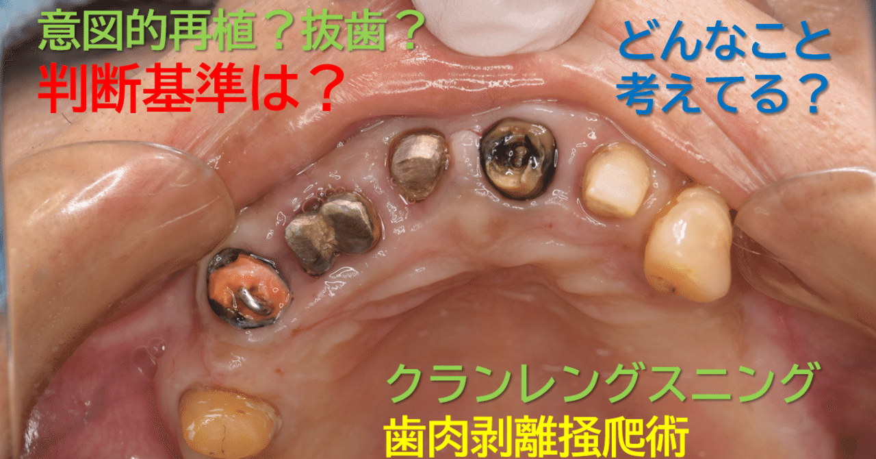 どうする縁下カリエス、慢性根尖性歯周炎、重度慢性歯周炎！？～歯槽骨