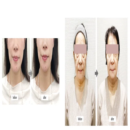 セルフHIFU（ハイフ）でお顔のたるみを改善、憧れの小顔に！｜VenusLash