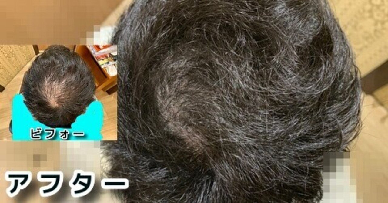 育毛のプロが教える髪が増える髪が太くなるすごい方法 の新着タグ記事一覧 Note つくる つながる とどける