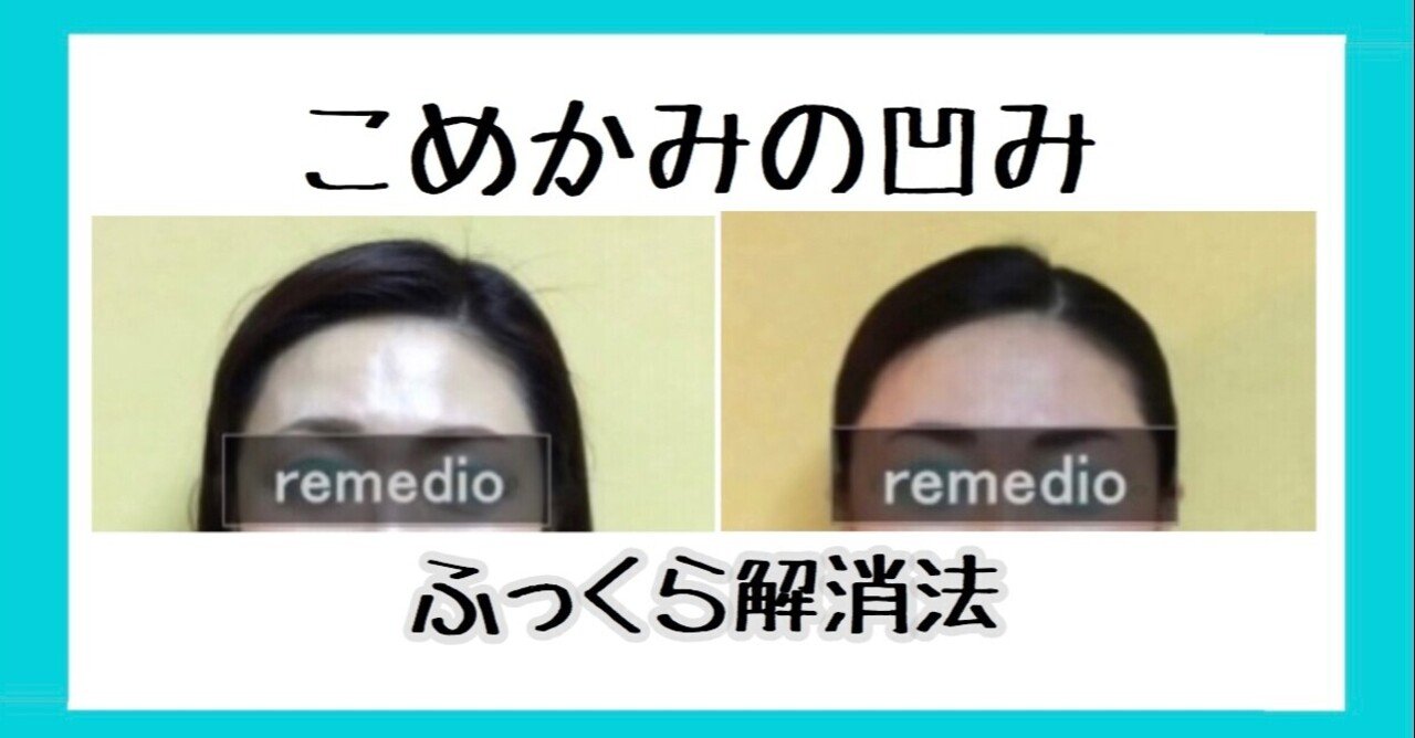 こめかみの凹みくぼみをなおす方法 頭皮マッサージとストレッチ お顔の整体師 戸塚哲春 Note こめかみの凹みくぼみをなおす方法 頭皮マッサージとストレッチ お顔の整体師 戸塚哲春 Note