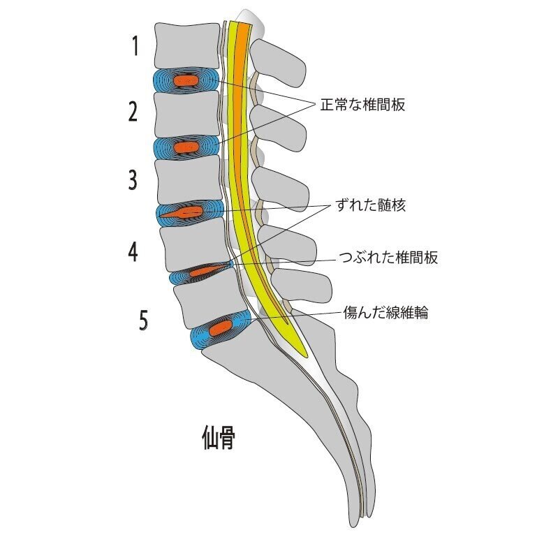 腰の椎間板　イラスト