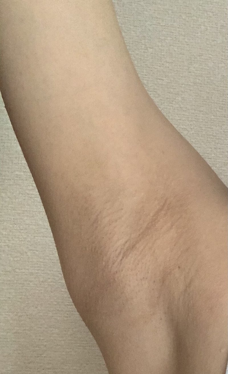 湘南美容外科ワキ脱毛 加工無しワキ画像あり みどち Note