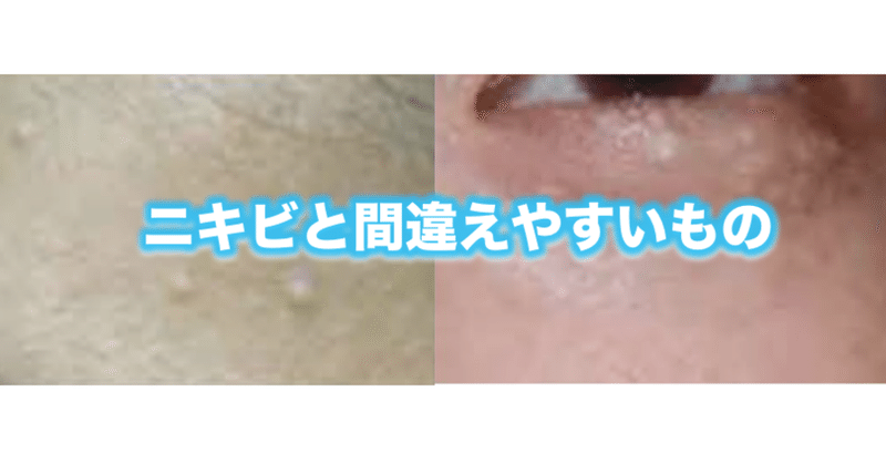 稗粒腫 はいりゅうしゅ と汗管腫 かんかんしゅ 片柳ちひろ ニキビ博士 Note 稗粒腫 はいりゅうしゅ と汗管腫 かんかんしゅ 片柳ちひろ ニキビ博士 Note