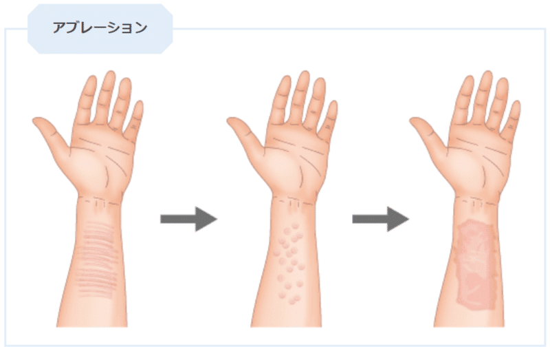 リストカットや根性焼きの傷跡を隠すことはできる 方法や気になる疑問を解説 高須クリニック公式 Note リストカットや根性焼きの傷跡を隠すことはできる 方法や気になる疑問を解説 高須クリニック公式 Note