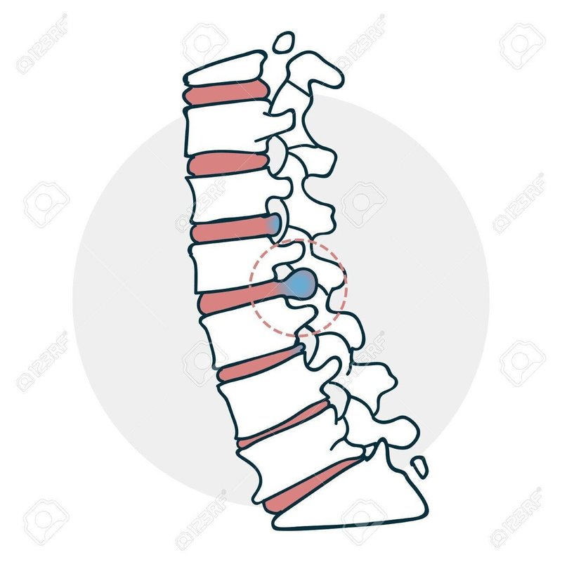 72939269-椎間板ヘルニアの椎間板のアイコン。診療科目のアイコン。面白い漫画スタイルのイラスト