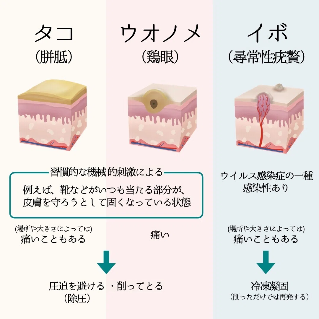 イボ と タコ の 違い