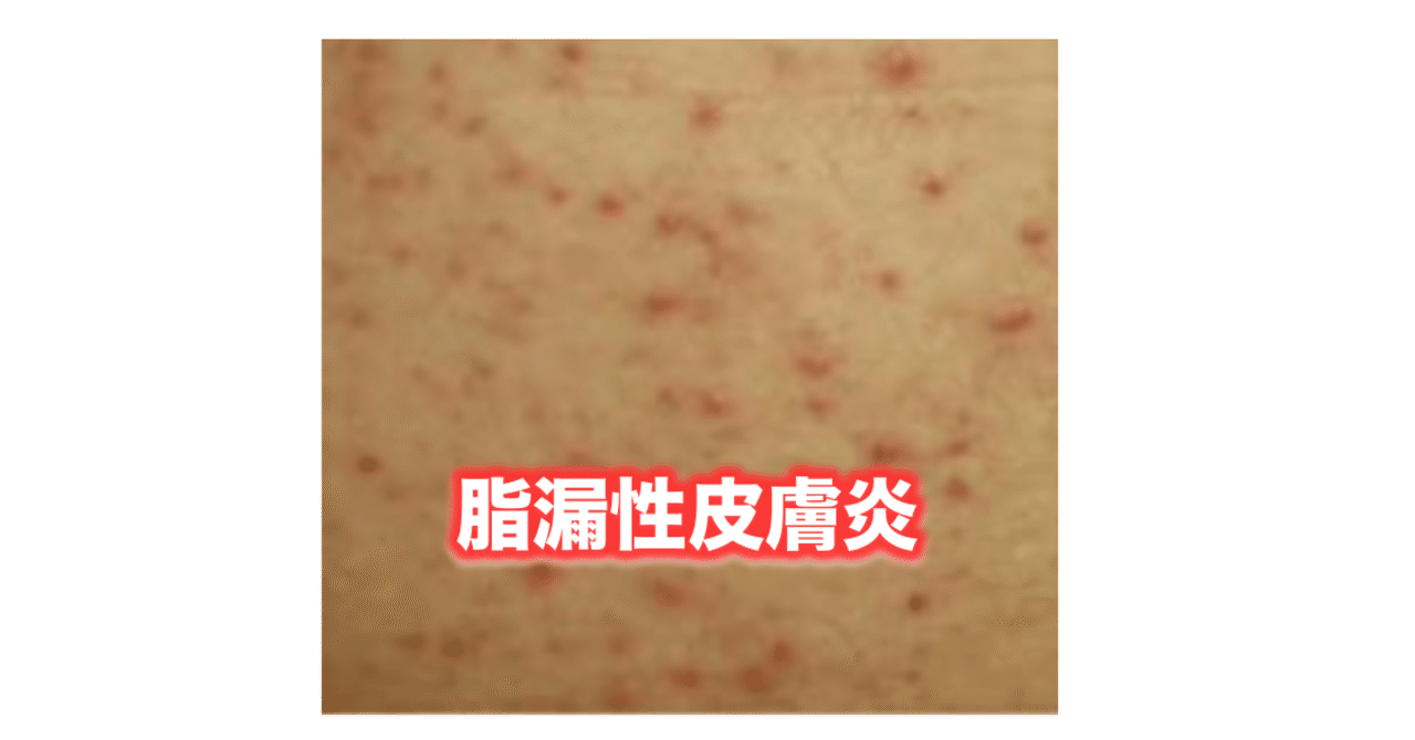 脂漏性皮膚炎 片柳ちひろ ニキビ博士 Note
