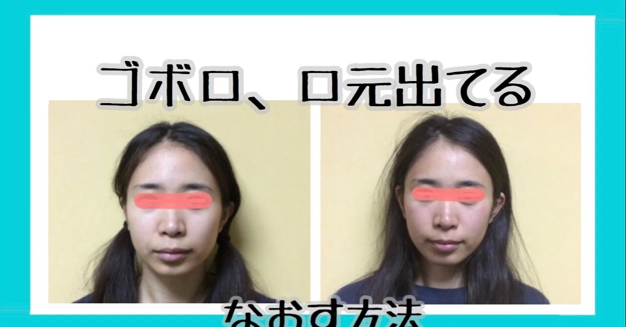 口ゴボ 横顔 これは口ゴボでしょうか 歯の矯正をしたら治 Q A Cosme アットコスメ