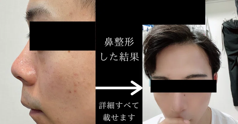 整形note 鼻フルコース整形の失敗と成功 ディック マッチングアプリ専門カメラマン Note
