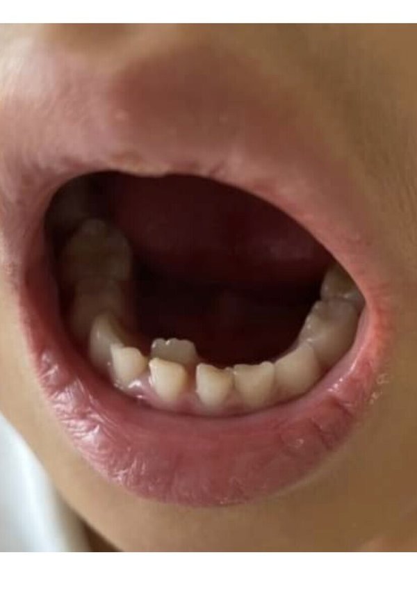 子供の歯の萌え変わり なかなか抜けない乳歯がある場合は 歯のブログ