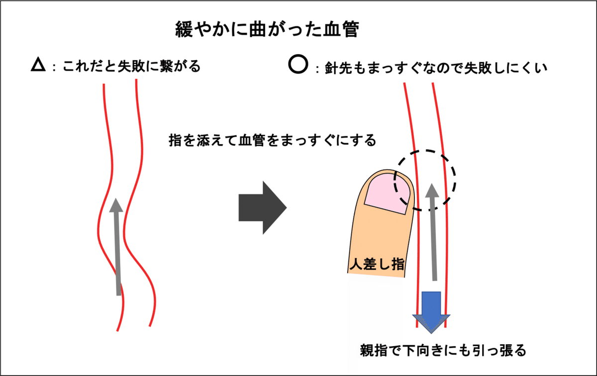 緩やかに曲がった血管