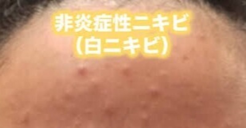 白ニキビ の新着タグ記事一覧 Note つくる つながる とどける 白ニキビ の新着タグ記事一覧 Note つくる つながる とどける