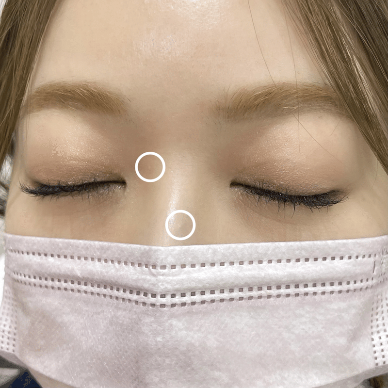稗粒腫 はいりゅうしゅ を取ってきた 千葉由佳 ちばゆか Note