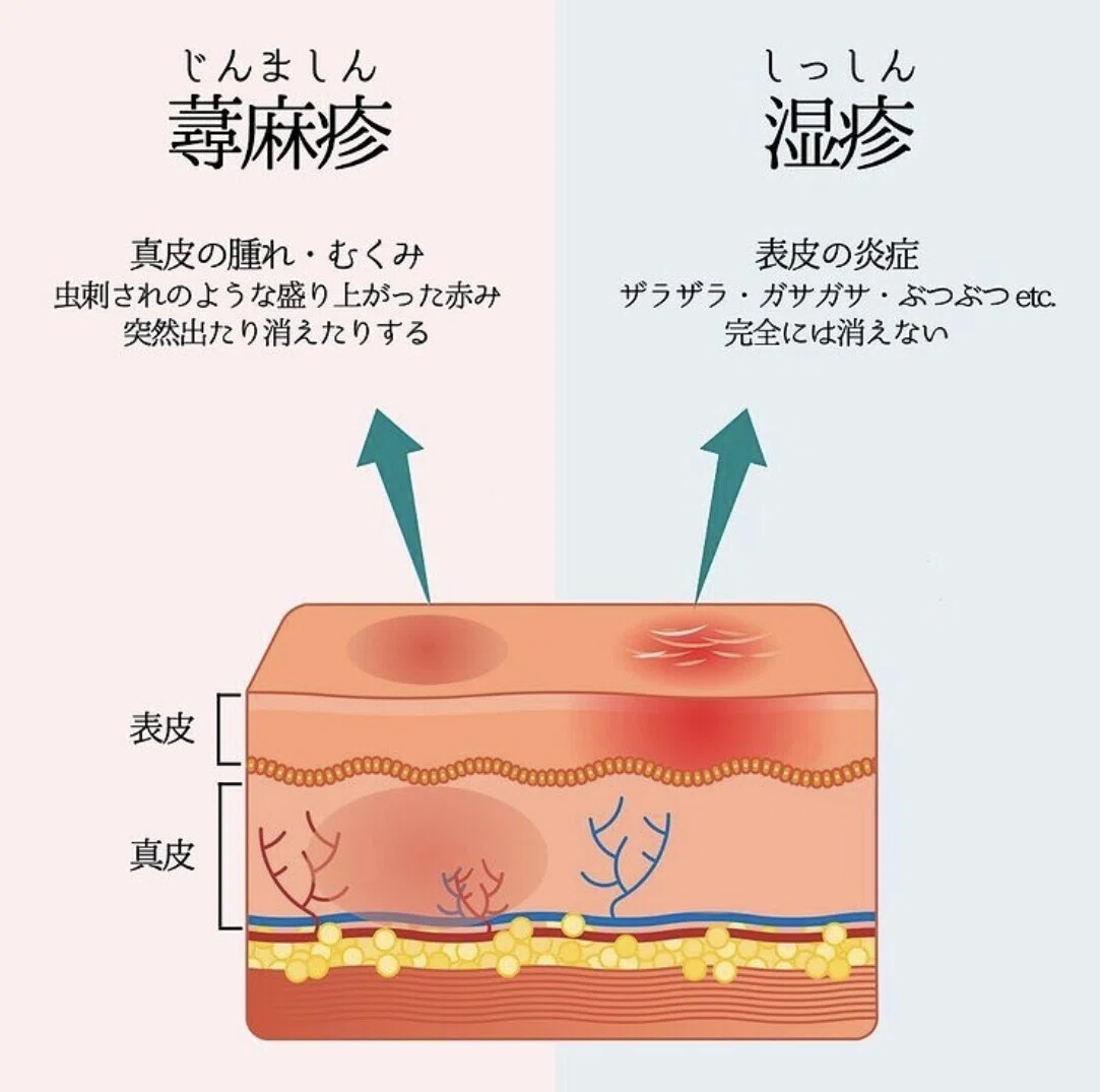 発疹 湿疹 違い