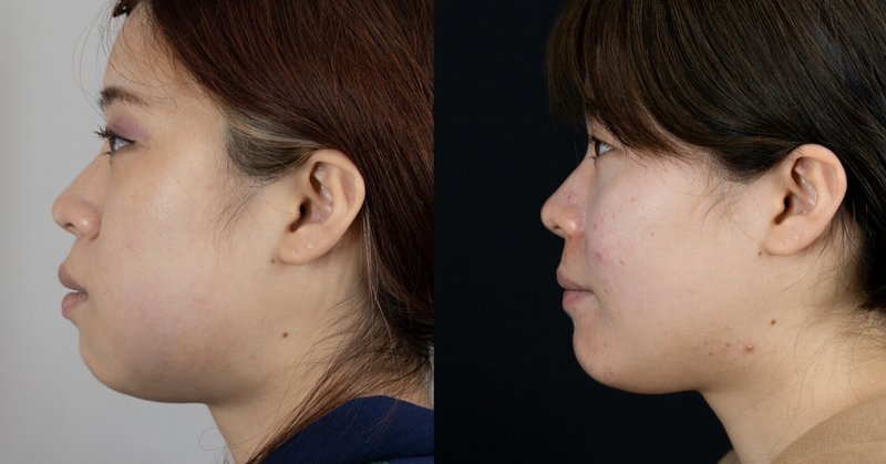 ゴボ口を治す両顎手術 術後３か月 抜歯下矯正では変わらない輪郭 骨切りドクター宮崎 Note