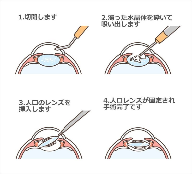 白内障手術体験記 選定療養で多焦点眼内レンズを使用してみた ハロー グレア図解付き デイブ Davetanaka Note