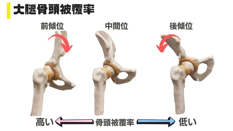 大腿骨頭被覆率前後傾