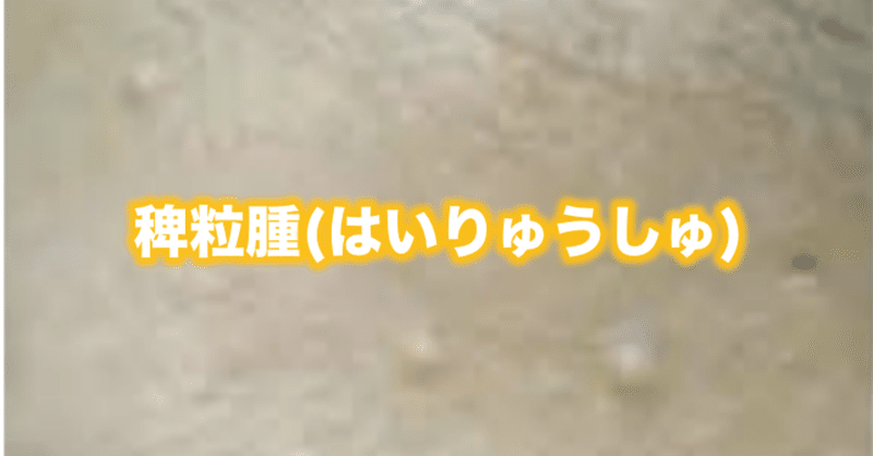 稗粒腫 はいりゅうしゅ 片柳ちひろ ニキビ博士 Note