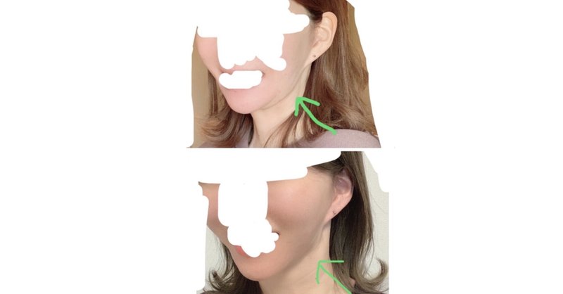 フェイスラインのもたつきと切らずに戦ってみた クリニック 料金公開 うに Note