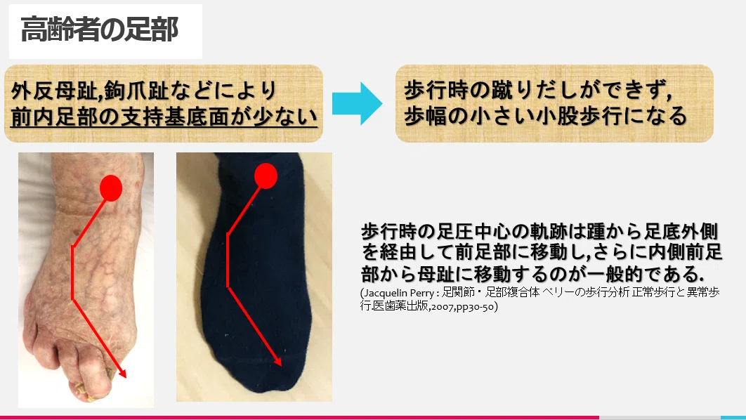 転倒について 第3回 《高齢者の足部,膝の拘縮および活動機会減少の影響