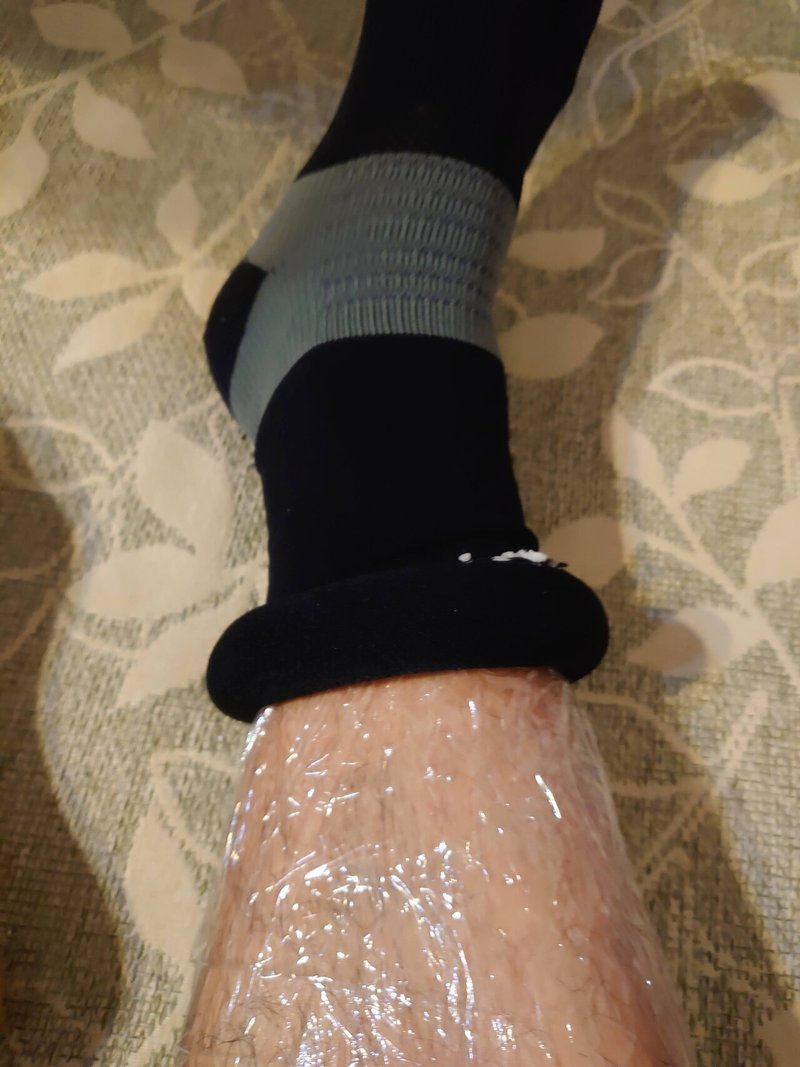 グロ注意 魚鱗癬のオッサンが足にラップを巻いて考察してみた 魚鱗癬は治るのかblog すこやかバリデーション Note