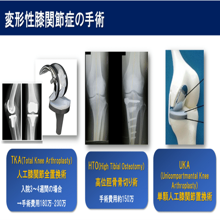 知っておきたい人工膝関節のこと｜石本浩之@柔道整復師