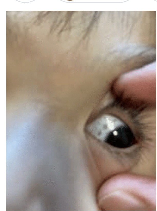 46 子供の目に白い斑点 強い日差し 子供の目は想像以上に澄んでいる くみ シリコンバレー情報発信 Note