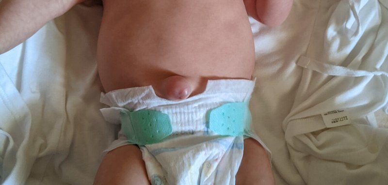 赤ちゃんが でべそ 臍ヘルニア でした Fumika Note