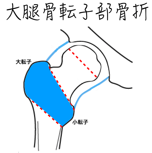 転子部骨折