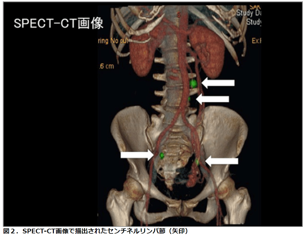 ロボット支援下 腹腔鏡下子宮悪性腫瘍手術 -work.07-｜Yama