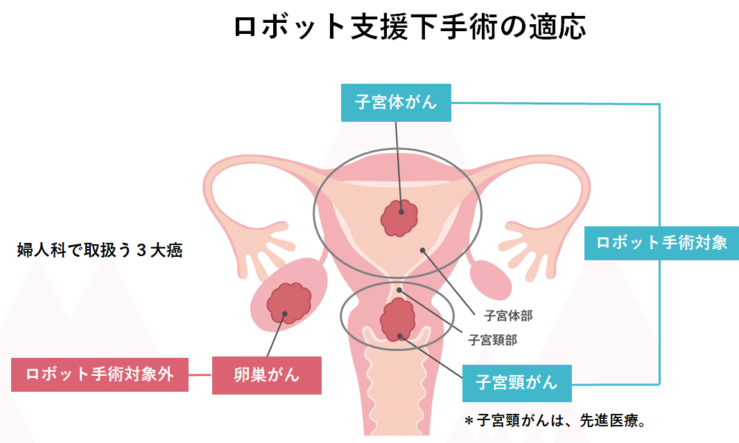 開腹・腹腔鏡・ロボット 産婦人科手術のための基礎知識 (OGS NOW
