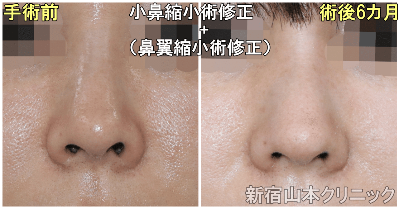 小鼻縮小術の失敗の体験談 修正ができないものもありますか 新宿 山本クリニック Note 小鼻縮小術の失敗の体験談 修正ができないものもありますか 新宿 山本クリニック Note