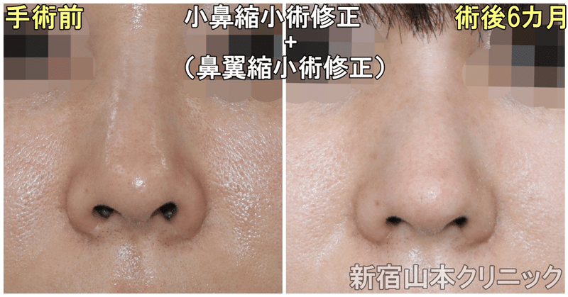 小鼻縮小術って失敗したらどうするの 新宿 山本クリニック Note