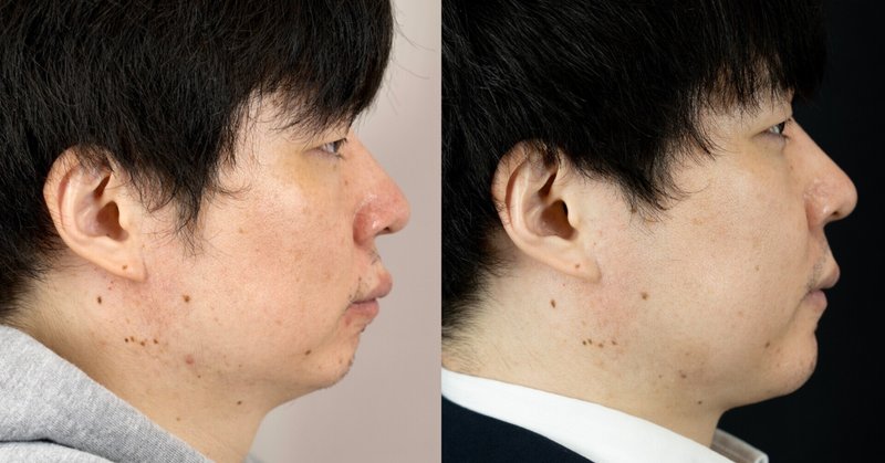 両顎手術 の新着タグ記事一覧 Note つくる つながる とどける 両顎手術 の新着タグ記事一覧 Note つくる つながる とどける