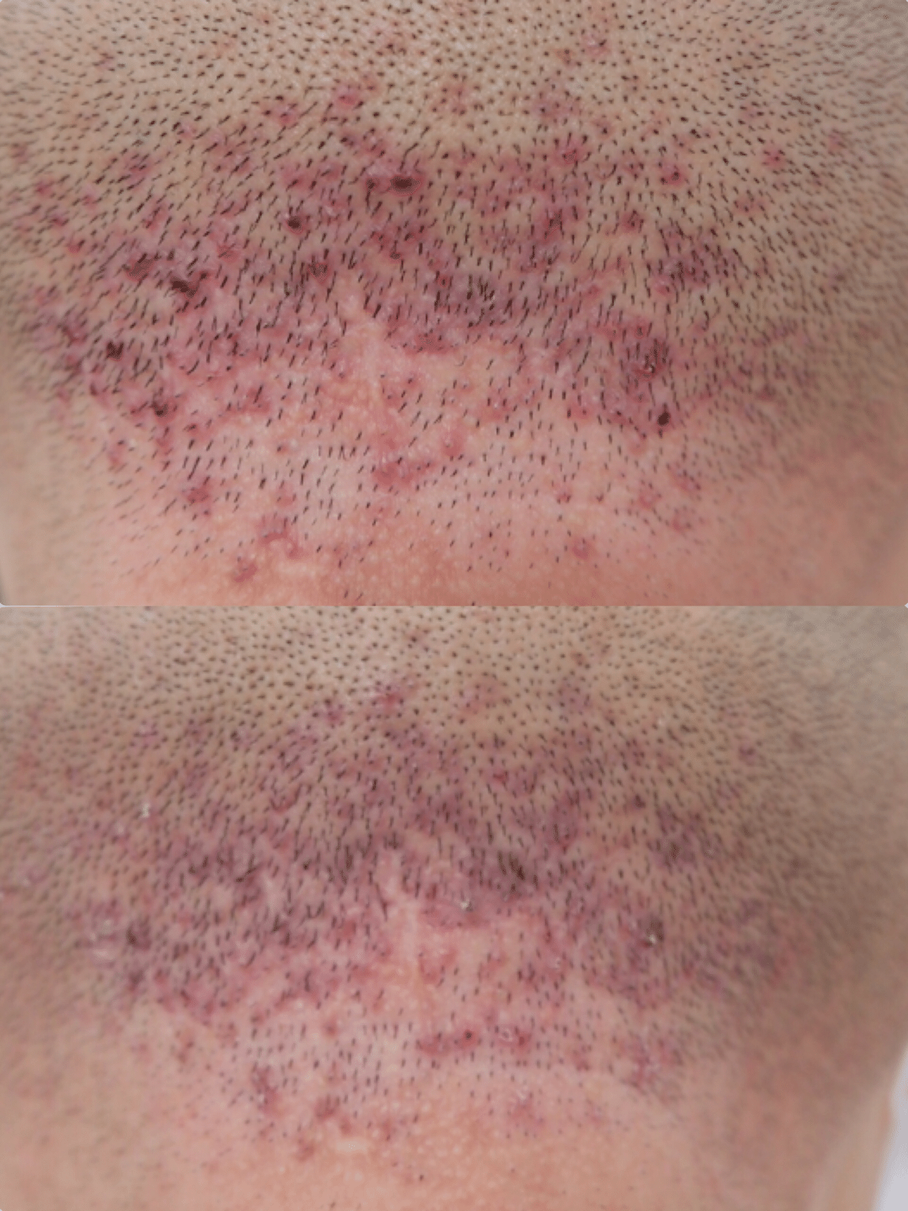 ハイドラフェイシャル その1 我孫子東邦クリニック Note