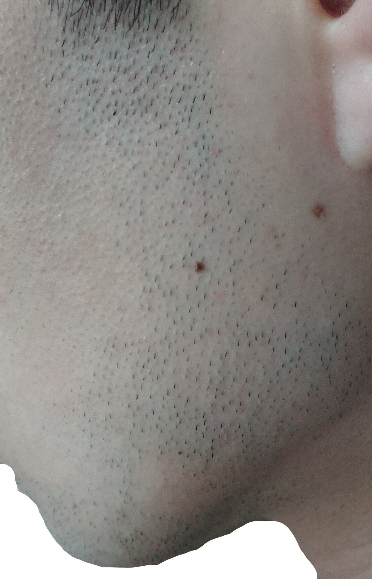 左もみあげ脱毛開始前24時間後