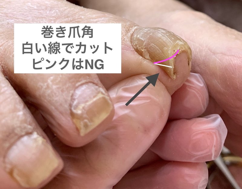 巻き爪 の切り方 角を切ってないけない 高齢者を足から笑顔に 中西薫 Note