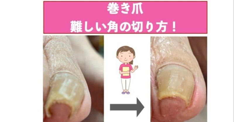 巻き爪 の切り方 角を切ってないけない 高齢者を足から笑顔に 中西薫 Note 巻き爪 の切り方 角を切ってないけない 高齢者を足から笑顔に 中西薫 Note