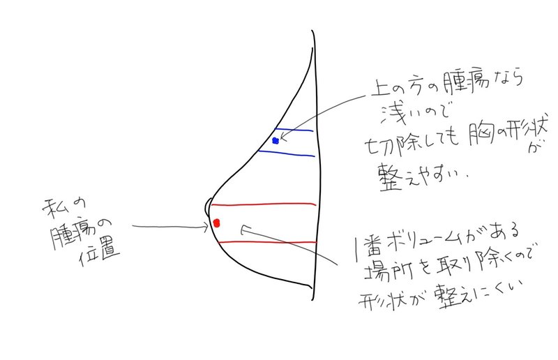 乳がん闘病記 14 寄せて集める 衝撃の部分切除方法 Tabineko Company Note 乳がん闘病記 14 寄せて集める 衝撃の部分切除方法 Tabineko Company Note