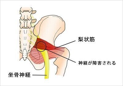 坐骨神経痛に効果があった梨状筋の筋膜リリース 足利市パーソナルジムトレーナー小泉智明 Note 坐骨神経痛に効果があった梨状筋の筋膜リリース 足利市パーソナルジムトレーナー小泉智明 Note