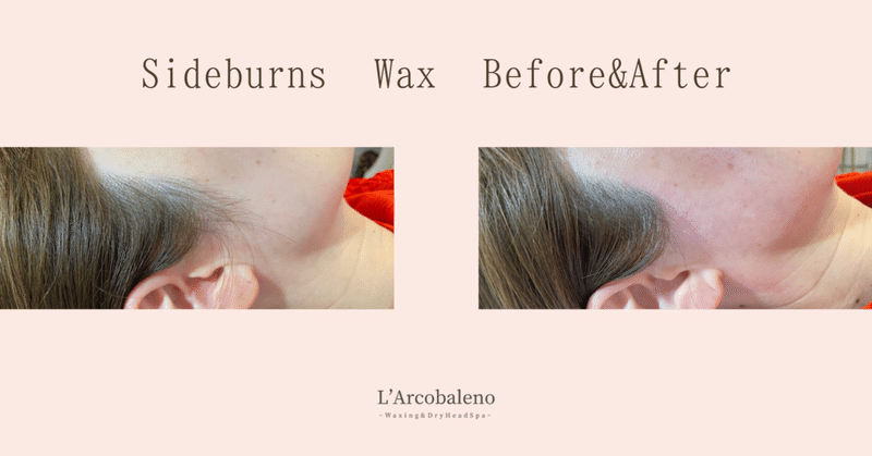 もみあげ脱毛ビフォーアフター セルフお手入れが難しい部位は ワックスにお任せあれ Arisa Yamasaki Note