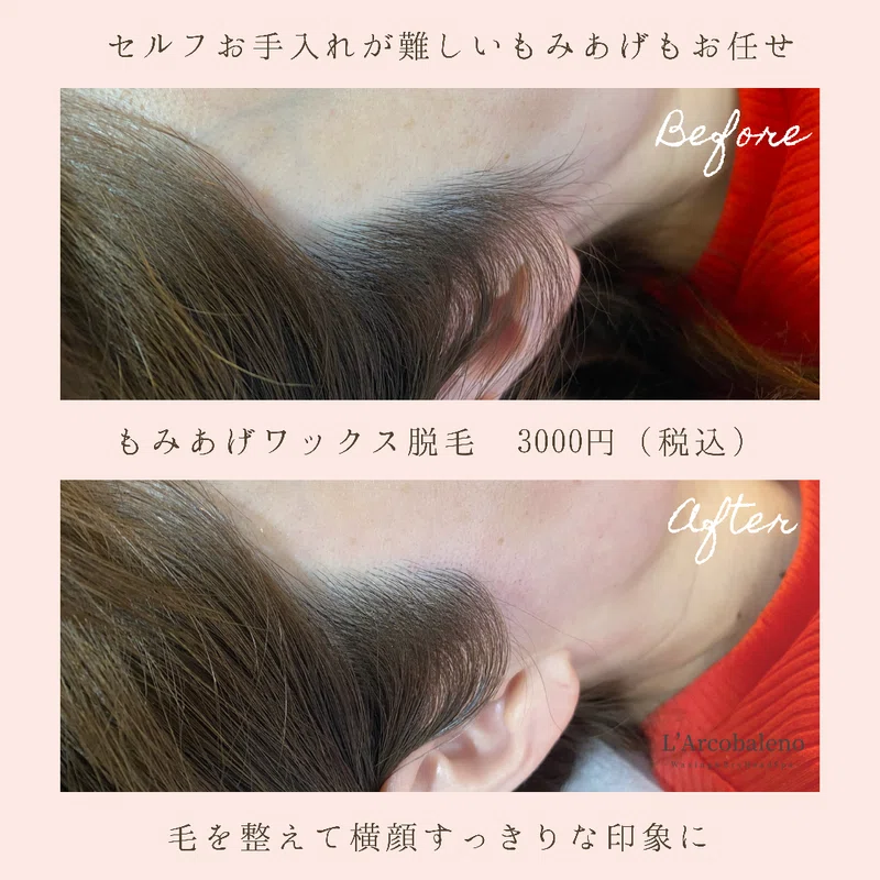 もみあげ脱毛ビフォーアフター セルフお手入れが難しい部位は ワックスにお任せあれ Arisa Yamasaki Note