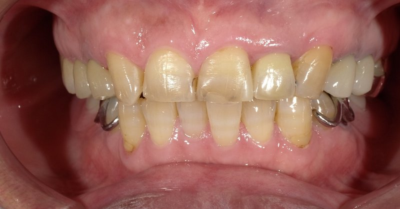 臼歯の審美修復
