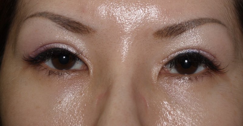 二重全切開 3 目頭切開失敗 Marilyn Note