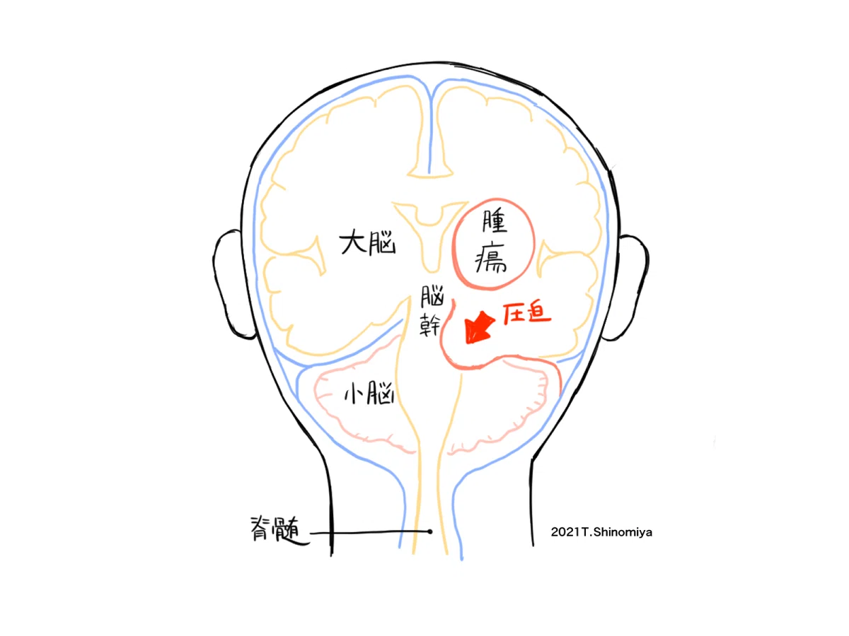 脳 ヘルニア 症状