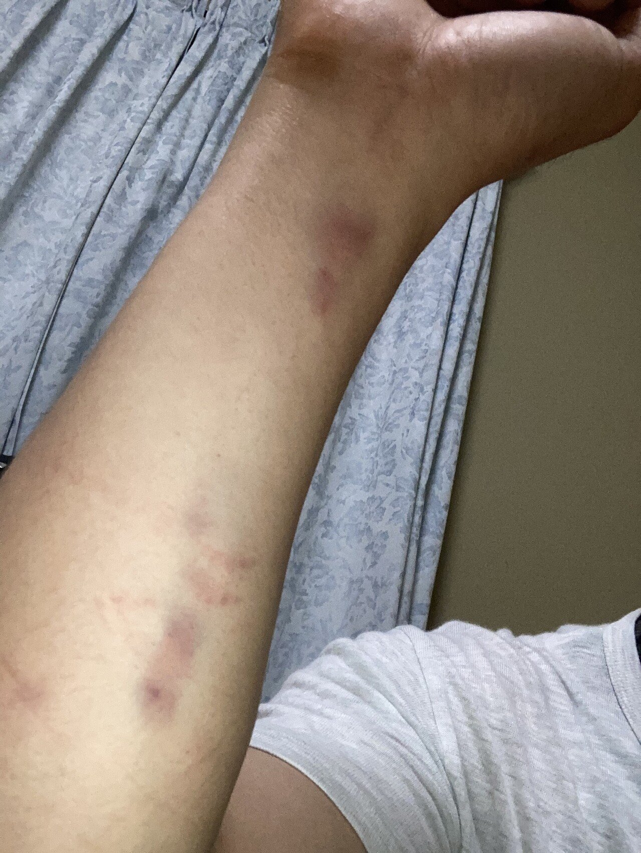 昨日のキックボクササイズで前腕が『青痣だらけ』なのですが