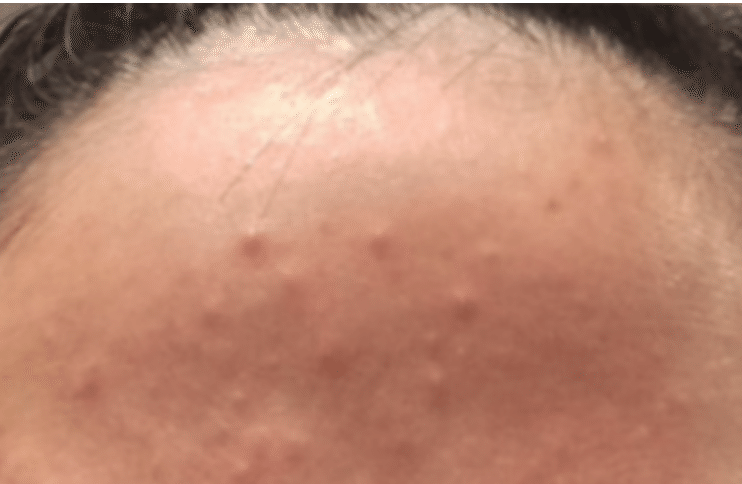 非炎症性ニキビ 白ニキビ 片柳ちひろ ニキビ博士 Note